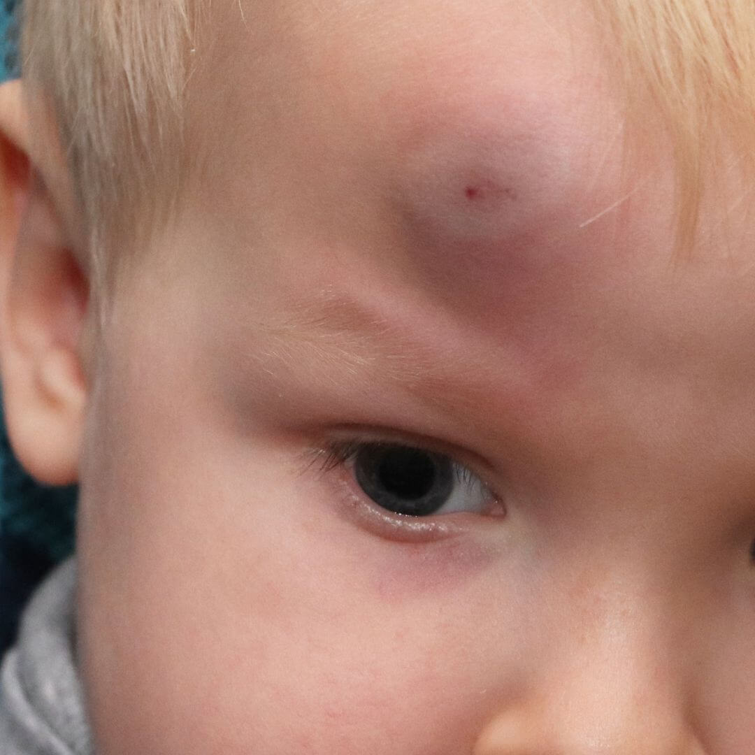 Boiron Blog Image Bump Haematoma